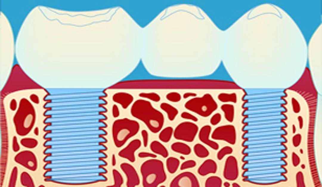 Implantatbro – erstatte flere tenner