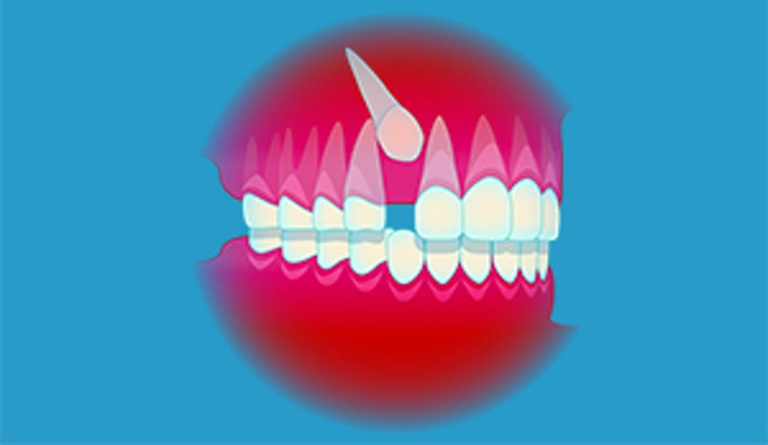 Fremføring av retinert tann