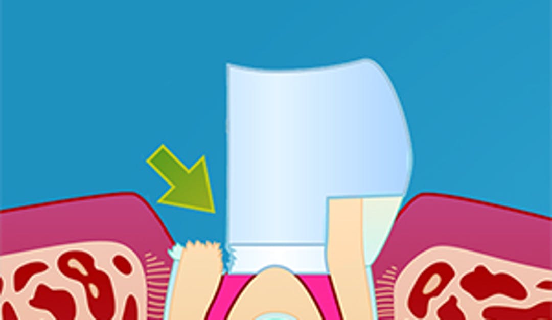 Reinfisert rotfylling