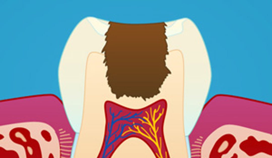 Trinnvis ekskavering